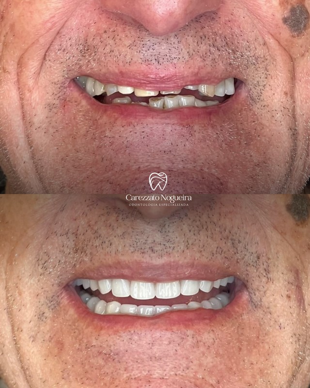 Antes e depois da reabilitação de um paciente da clínica: em cima os dentes desgastados e ausentes, embaixo o sorriso refeito