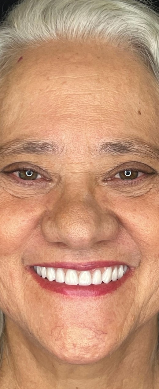 A mesma paciente depois da reabilitação, sorrindo